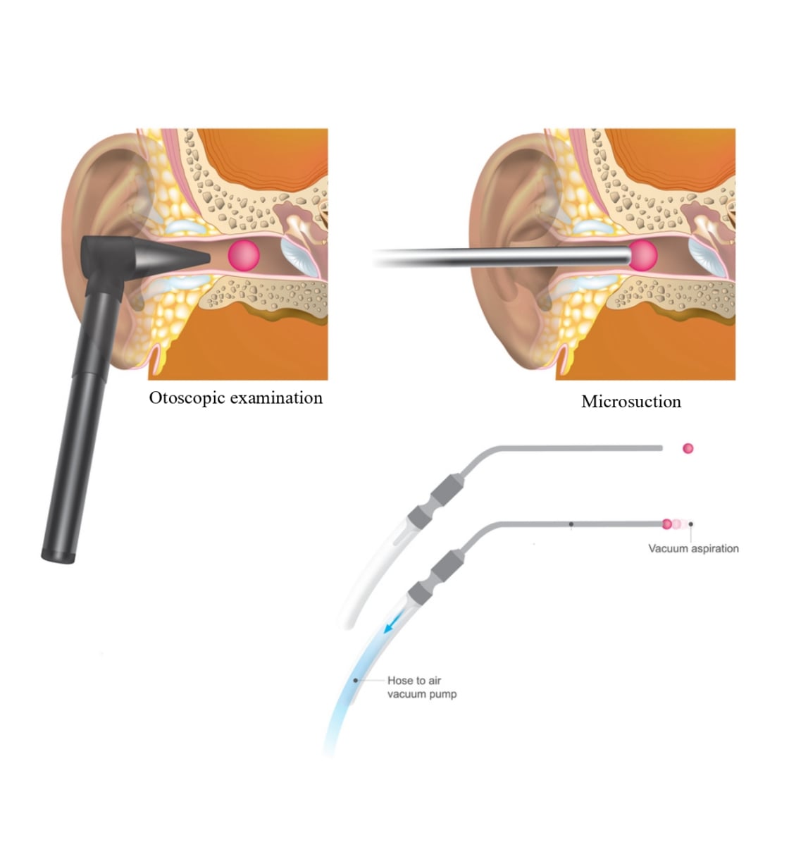 diagram of microsuction probe