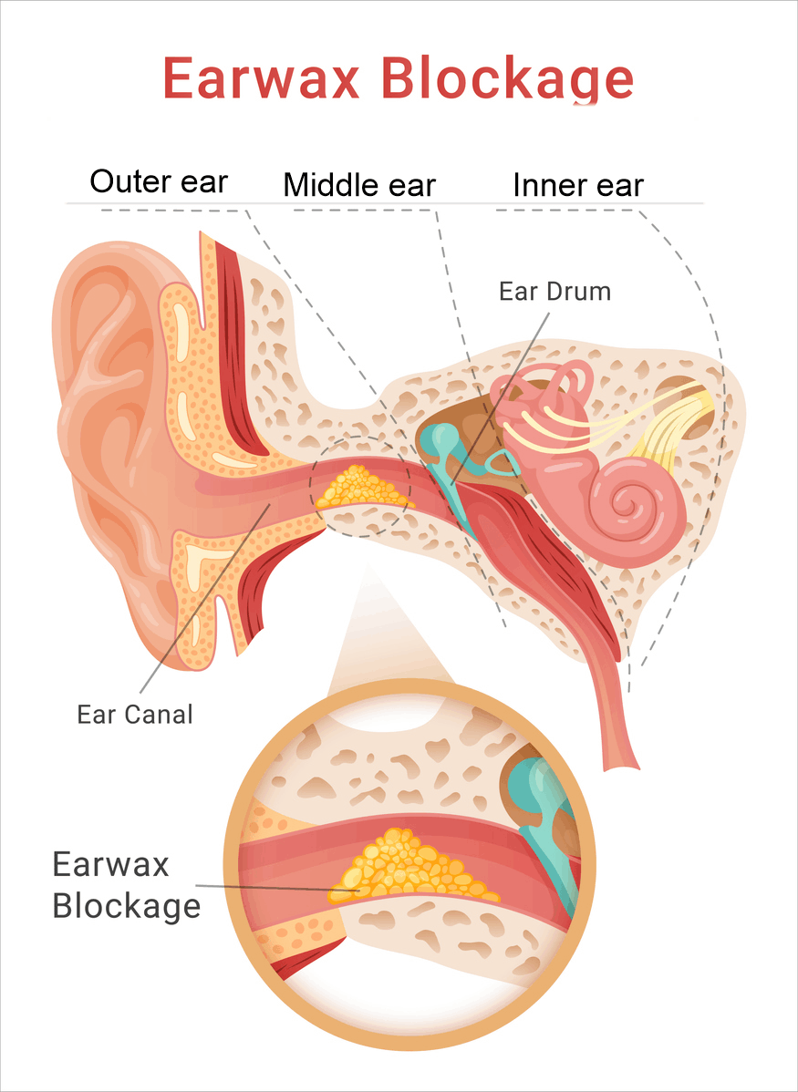 Diagram of earwax blockage